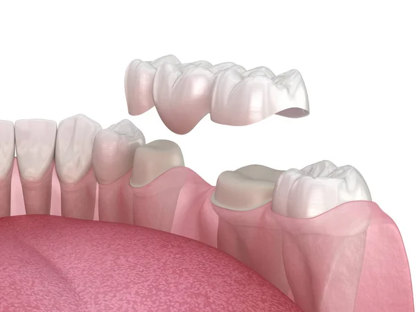 臼歯と前臼歯の上に3歯の歯科ブリッジ 人間の歯の治療の医学的に正確な3Dイラスト — ストック写真