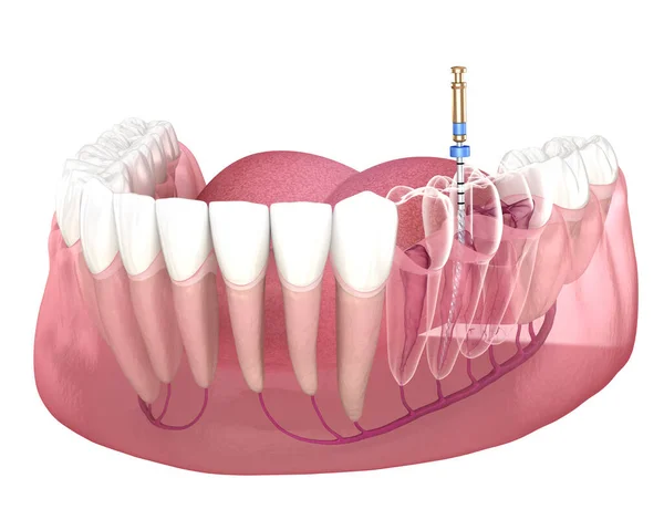 Proces Leczenia Kanałowego Endodontycznego Medycznie Dokładna Ilustracja Zęba — Zdjęcie stockowe