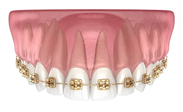 Aparelhos Dourados Tretament Vista Macro Ilustração Odontológica Medicamente Precisa — Fotografia de Stock
