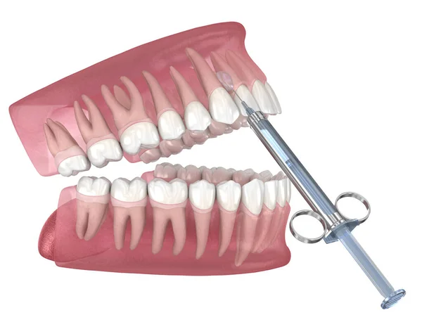 Anesthésie Dentaire Locale Illustration Traitement Dentaire — Photo