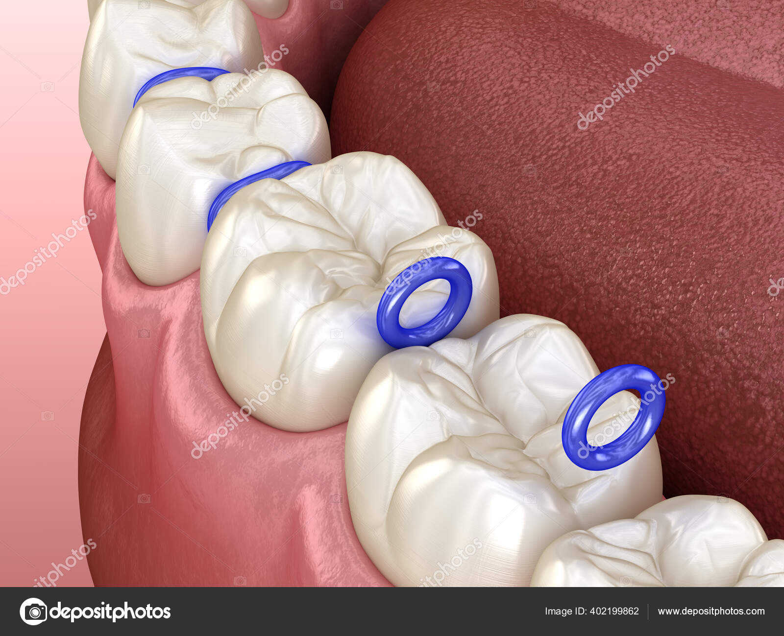 Rubber Separator Teeth Preparation Braces Placement Medically Accurate