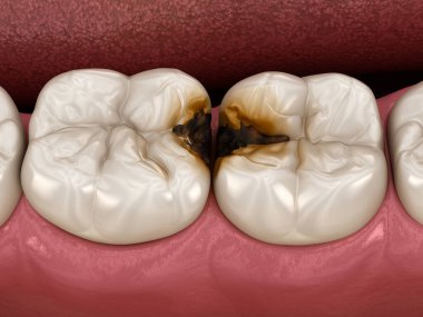 Azı dişleri bakirelerden zarar görmüş. Tıbbi olarak doğru diş 3D illüstrasyon.