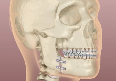 Mandibular Gelişim Cerrahisi. Tıbbi olarak doğru olan 3 boyutlu diş illüstrasyonu.