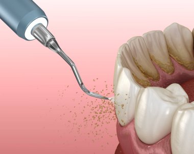 Ağız temizliği: Ölçekleme ve kök planlama (geleneksel periodontal terapi). İnsan diş tedavisinin tıbbi açıdan doğru üç boyutlu çizimi