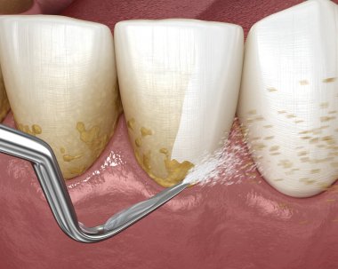 Ağız temizliği: Ölçekleme ve kök planlama (geleneksel periodontal terapi). İnsan diş tedavisinin tıbbi açıdan doğru üç boyutlu çizimi