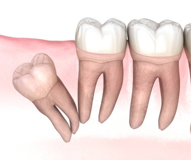 Bilgelik dişinin uzak etkisi. Tıbbi olarak doğru diş 3D illüstrasyon