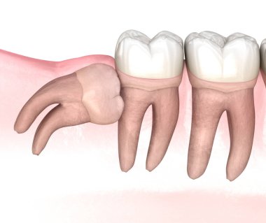 Bilgelik dişinin yatay etkisi. Tıbbi olarak doğru diş 3D illüstrasyon