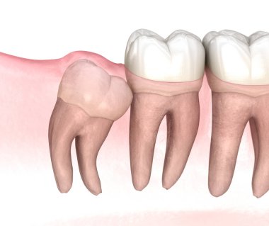 Yirmilik dişin kafa karıştırıcı etkisi. Tıbbi olarak doğru diş 3D illüstrasyon