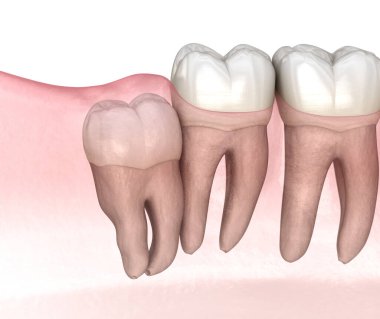 Bilgelik dişinin dikey etkisi. Tıbbi olarak doğru diş 3D illüstrasyon