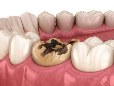 Caries çıkarma işlemi. Tıbbi olarak doğru diş 3D illüstrasyon.