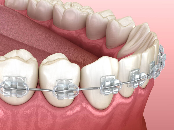 Mandibular jaw and Clear braces. Medically accurate dental 3D illustration