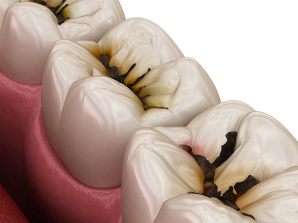 Зубы зубов повреждены кариесом. Медицинская точность трехмерной иллюстрации зубов.