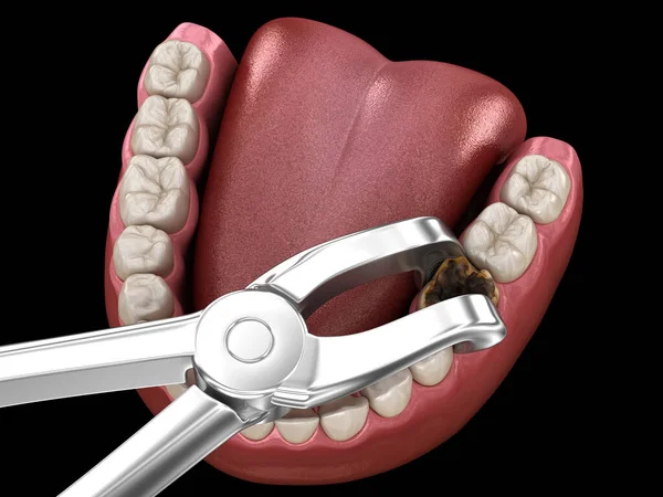 Удаление Зуба Поврежденного Кариесом Медицинская Точность Трехмерной Иллюстрации Зубов — стоковое фото