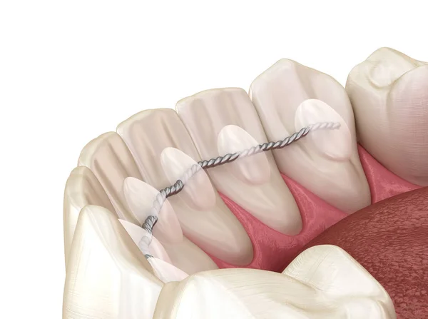 Retenedores Dentales Instalados Después Del Tratamiento Con Aparatos Ortopédicos Ilustración —  Fotos de Stock