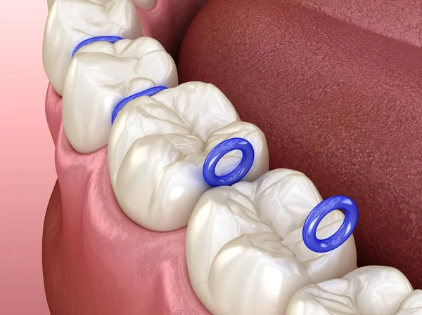 Separator Gumy Między Zębami Przygotowanie Umieszczenia Aparatu Zęby Medycznie Dokładna — Zdjęcie stockowe