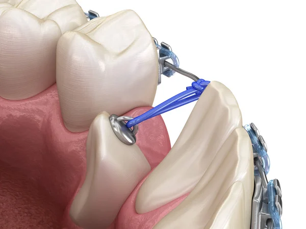 Impacted Cuspid Elástico Para Correção Ilustração Odontológica Medicamente Precisa — Fotografia de Stock