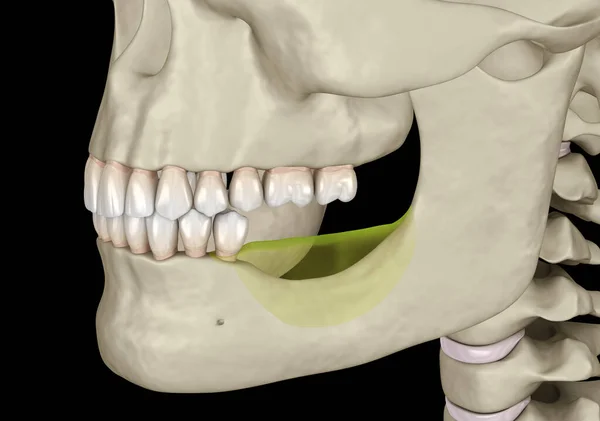 Mandíbula Mandibular Recesión Ósea Después Perder Los Dientes Molares Ilustración —  Fotos de Stock