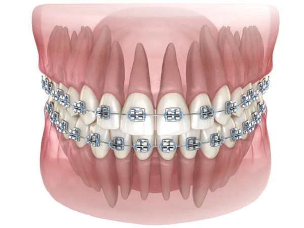 Металлические Брекеты Прозрачная Зубная Модель Медицинская Точность Иллюстрации — стоковое фото
