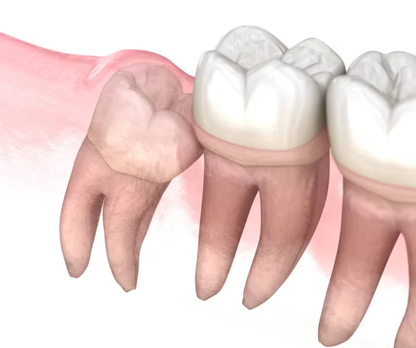 Mesial impaction of Wisdom tooth. Medically accurate tooth 3D illustration