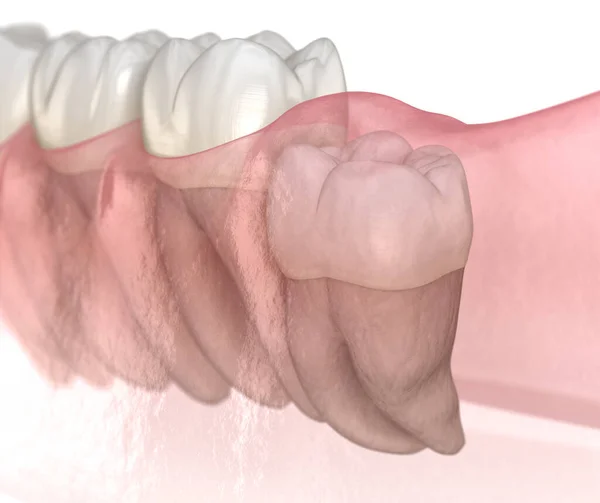 Impacção Vertical Dente Sabedoria Ilustração Dente Medicamente Precisa — Fotografia de Stock