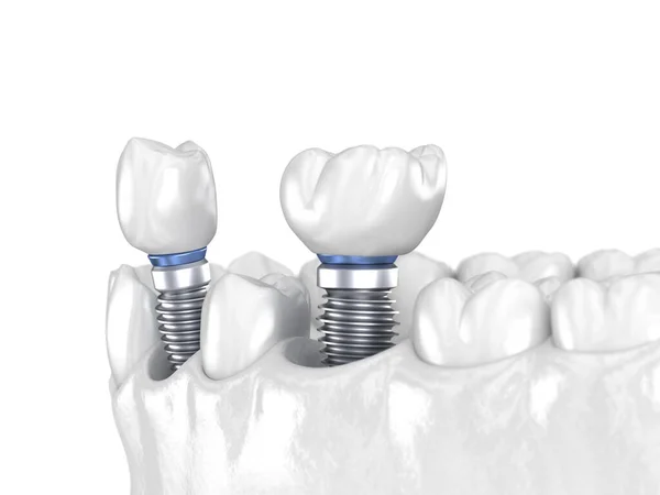 Instalación Corona Dentaria Premolar Molar Sobre Implante Concepto Blanco Ilustración — Foto de Stock