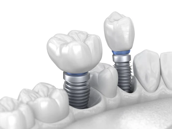 Installazione Della Corona Dentale Premolare Molare Impianto Concetto Bianco Illustrazione — Foto Stock