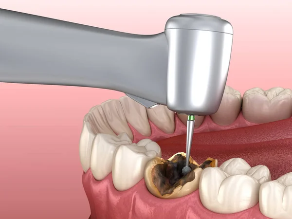 Carie Rimozione Processo Illustrazione Del Dente Clinicamente Accurata — Foto Stock