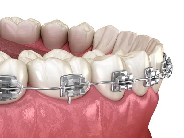 Metal Telli Sağlıklı Dişler Macro Manzaralı Tıbbi Olarak Doğru Olan — Stok fotoğraf