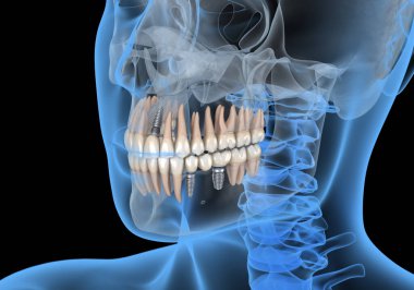 Diş implantlarıyla iyileşiyor. İnsan dişleri ve protez kavramının tıbben doğru üç boyutlu çizimi