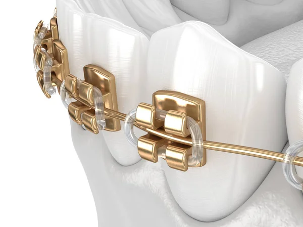 Healthy Teeth with gold braces, white teeth concept, dental 3D illustration