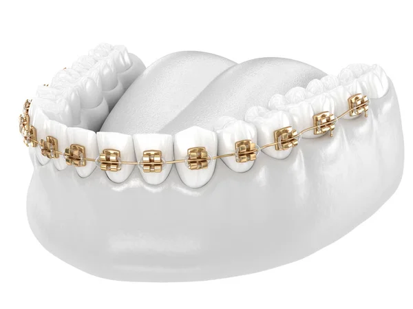 Healthy Teeth with gold braces, white teeth concept, dental 3D illustration