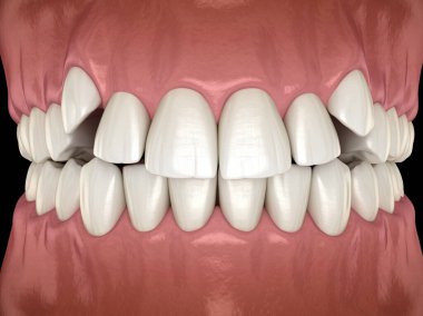 Impacted incisors, overcrowded teeth. Medically accurate 3D illustration of abnormal dental occlusion clipart