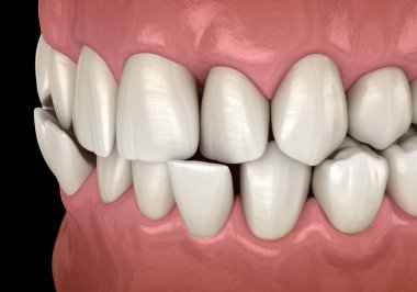 Ön çapraz diş tıkanıklığı (dişlerin Malocclusion 'ı). Tıbbi olarak doğru diş 3D illüstrasyon