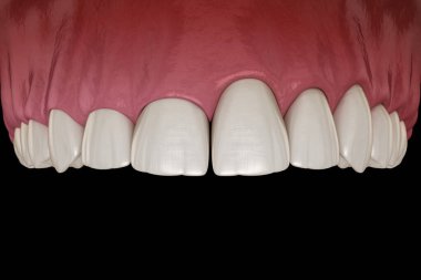 Lazerle Gingivectomi ameliyatı. Tıbbi olarak doğru diş 3D illüstrasyon