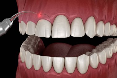 Lazerle Gingivectomi ameliyatı. Tıbbi olarak doğru diş 3D illüstrasyon