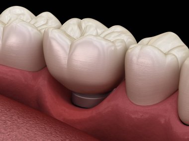 Çiklet durgunluğu olan Peri-implantitis. Diş implantı kavramının tıbben doğru üç boyutlu çizimi