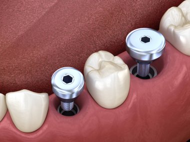Geçici implant aparatları. İnsan dişleri ve protez kavramının tıbben doğru üç boyutlu çizimi