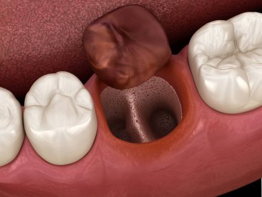 Alveolitler - diş çekildikten sonra kurudu. Tıbbi olarak doğru 3B illüstrasyon