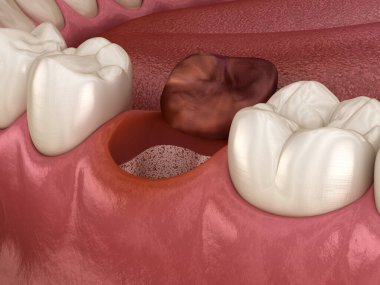 Alveolitler - diş çekildikten sonra kurudu. Tıbbi olarak doğru 3B illüstrasyon