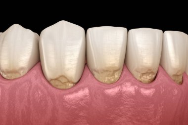 Ön dişlerde sıyrık var. Tıbbi olarak doğru 3B illüstrasyon
