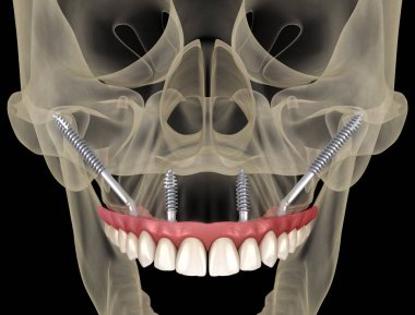 Elmacık kemiği implantları tarafından desteklenen Maxillary protezi. İnsan dişlerinin ve protezlerinin tıbbi açıdan doğru üç boyutlu çizimi