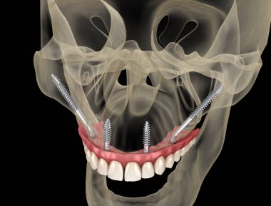 Elmacık kemiği implantları tarafından desteklenen Maxillary protezi. İnsan dişlerinin ve protezlerinin tıbbi açıdan doğru üç boyutlu çizimi