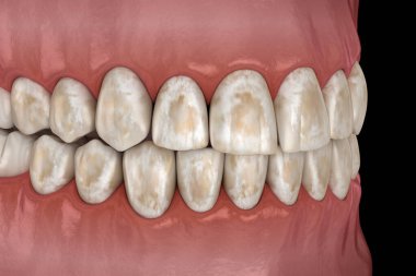 Diş mineralizasyonu, sert dokulardan minerallerin çıkarılması: diş minesi, dentin ve cementu. Tıbbi olarak doğru 3B illüstrasyon.