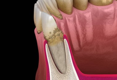 Periodontitis stage 1, gum recession, tartar. Medically accurate 3D illustration clipart