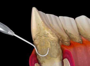 Oral hijyen: Periodontit 3. evrede (geleneksel periodontal terapi) ölçekleme ve kök planlama. İnsan diş tedavisinin tıbbi açıdan doğru üç boyutlu çizimi
