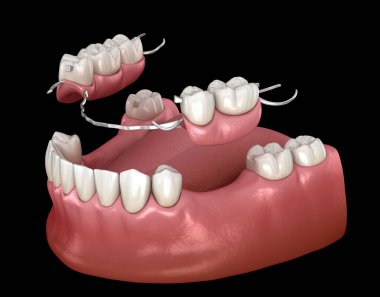 Çıkarılabilir kısmi takma diş, çene protezi. Medikal olarak protodontik konseptin 3 boyutlu çizimi
