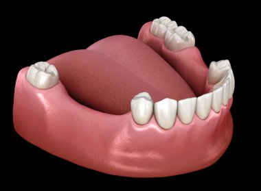 Çıkarılabilir kısmi takma diş, çene protezi. Medikal olarak protodontik konseptin 3 boyutlu çizimi