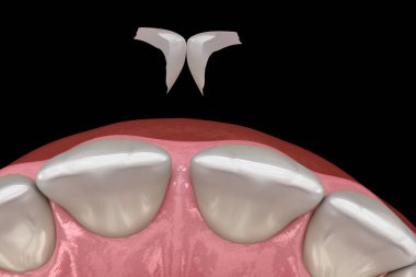 Diastema tedavisi: mikro kaplama kurulum prosedürü merkezi kesici diş üzerinde. Tıbbi olarak doğru diş 3D illüstrasyon