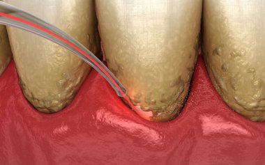 Lazer tartarı, enfekte olmuş deri tabakasını ve diş temizliğini temizler. Tıbbi olarak doğru diş 3D illüstrasyon