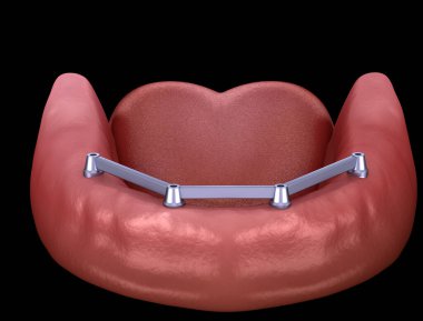 Removable Mandibular prosthesis with gum All on 4 system supported by implants. Medically accurate 3D illustration of human teeth and dentures clipart